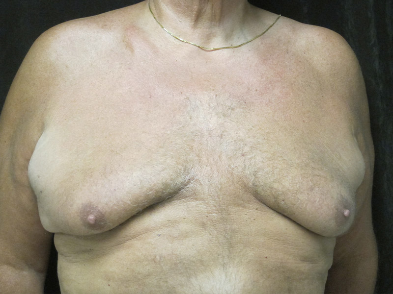 Gynecomastia Before and After 02