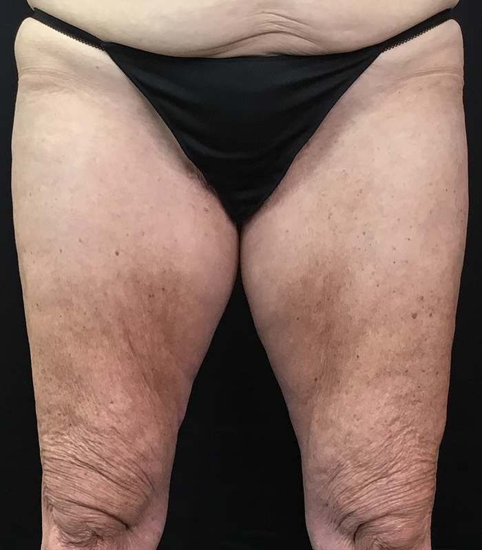 Thigh Lift Surgery Before and After Pictures, Scar Pictures